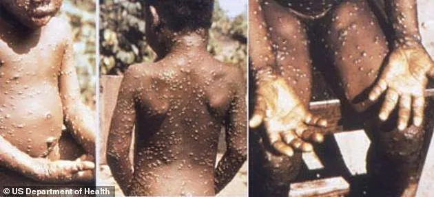 What is Monkeypox What are the symptoms, and how does it affect you