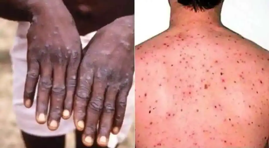 What is Monkeypox What are the symptoms, and how does it affect you 5