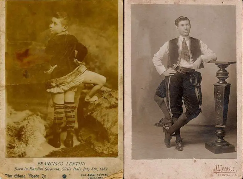 Frank Lentini, Three Legged Man With 16 Fingers, And Two Penises