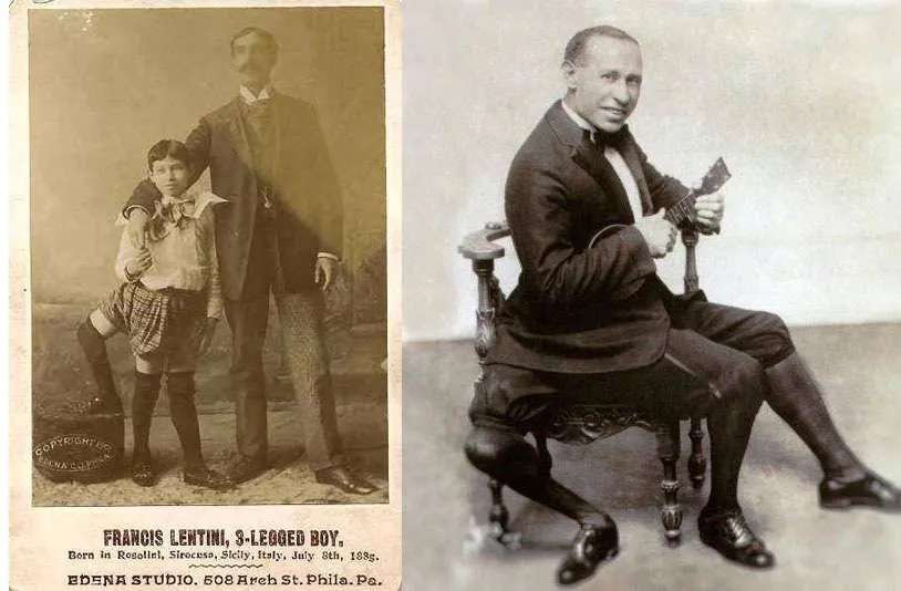 Frank Lentini, Three Legged Man With 16 Fingers, And Two Penises