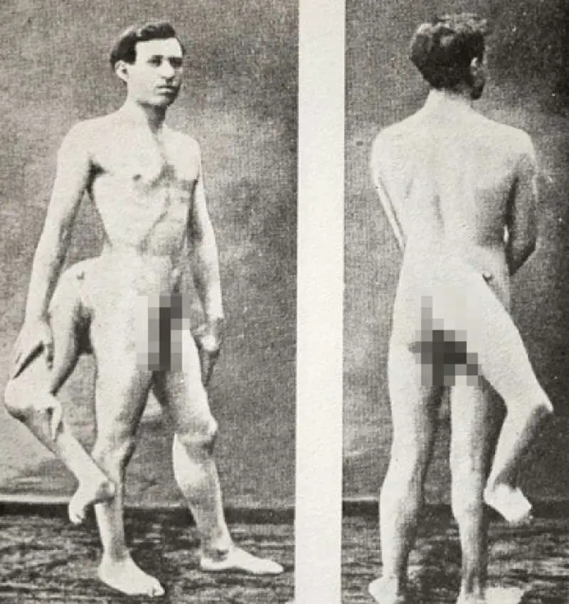 Frank Lentini, Three Legged Man With 16 Fingers, And Two Penises