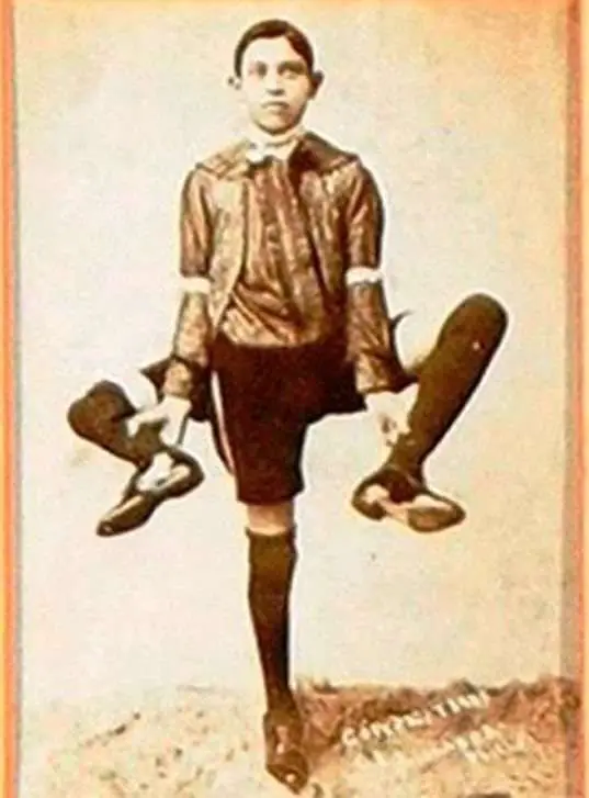 Frank Lentini, Three Legged Man With 16 Fingers, And Two Penises 7